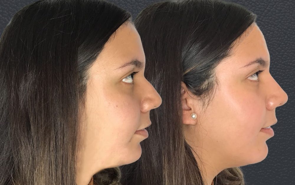 Before and after non-surgical nose job — bulbous tip