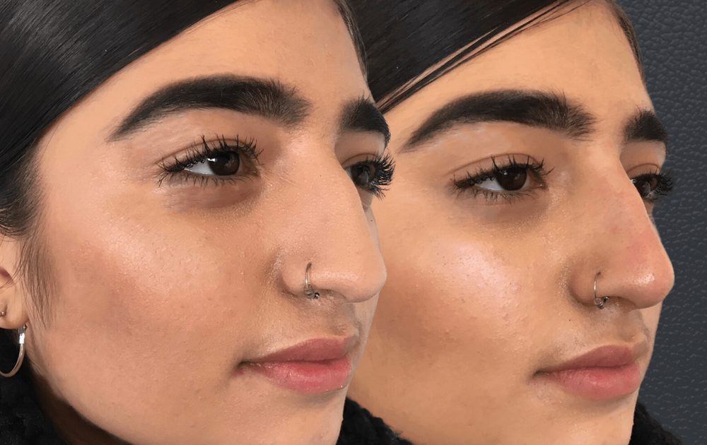 Before and after non-surgical nose job — bump on the bridge