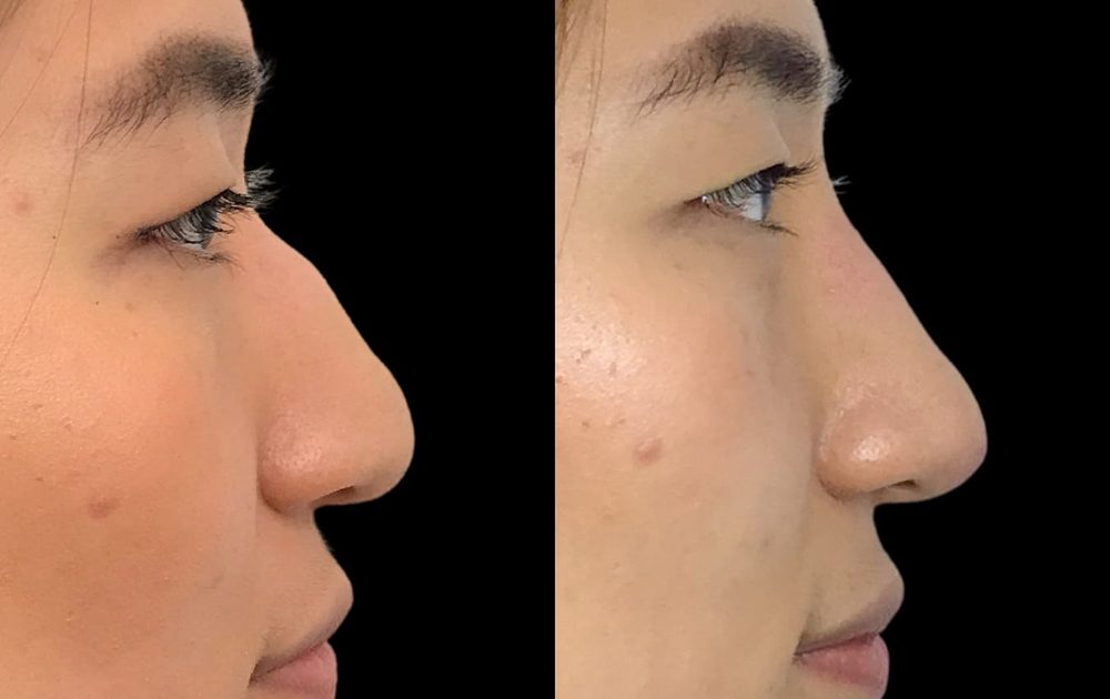 Before and after non-surgical nose job — low bridge and tip definition