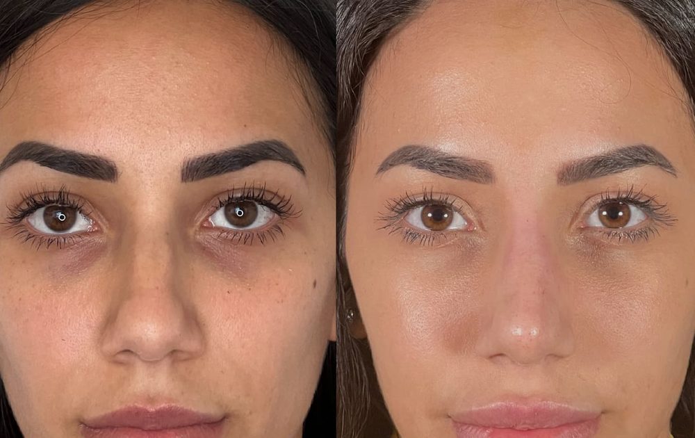 Before and after non-surgical nose job — bulbous tip