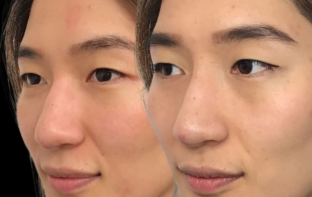Before and after non-surgical nose job — bridge enhancement