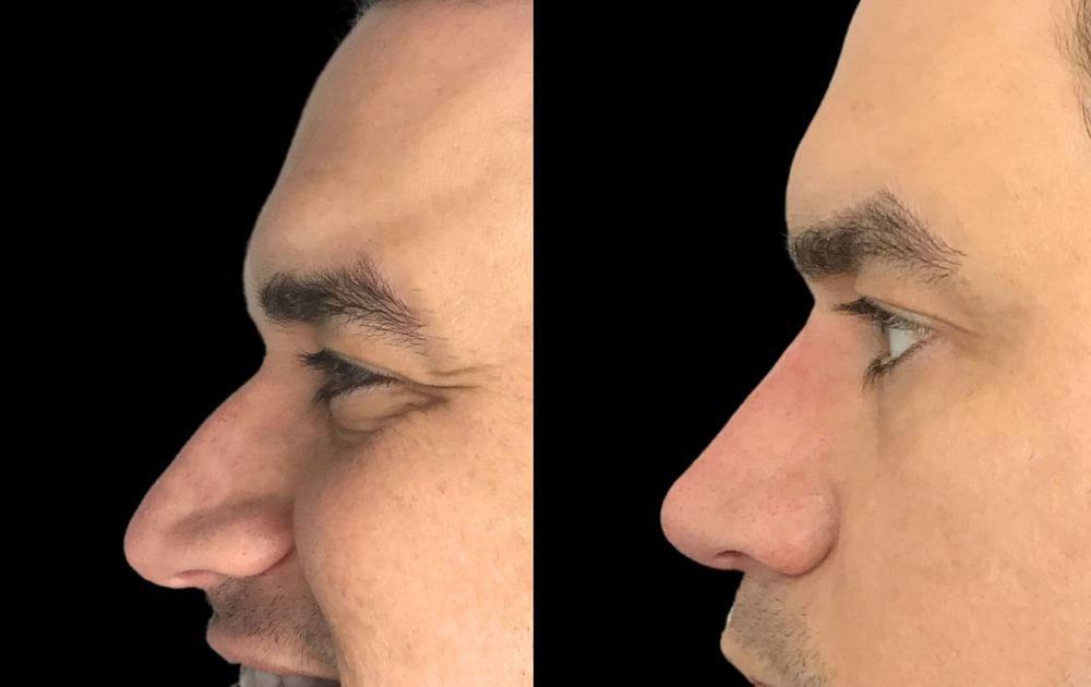 Before and after non-surgical nose job — droopy tip