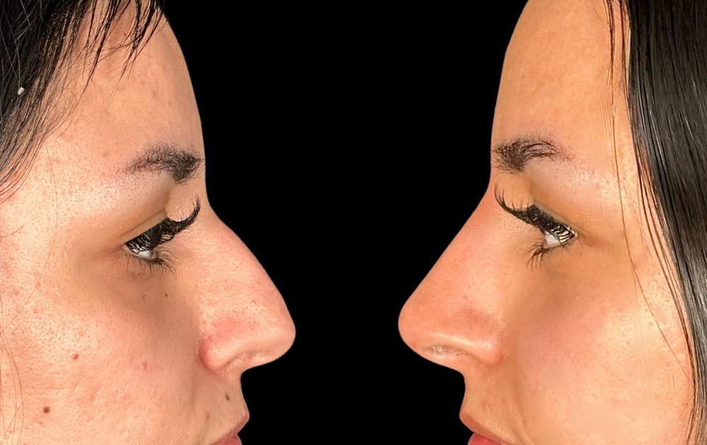 Before and after non-surgical nose job — droopy tip