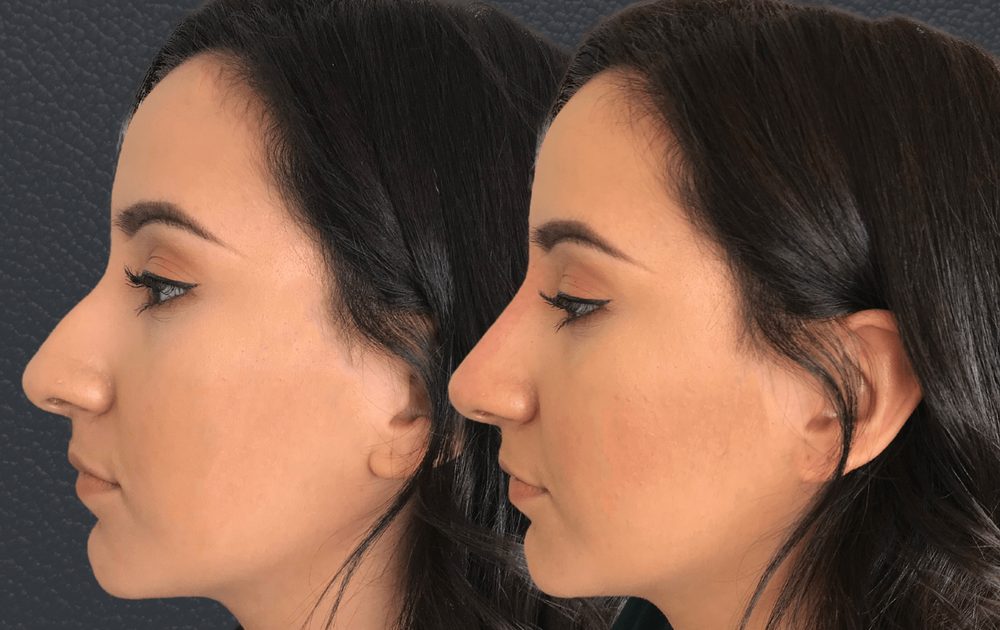 Before and after non-surgical nose job — bump and droopy tip