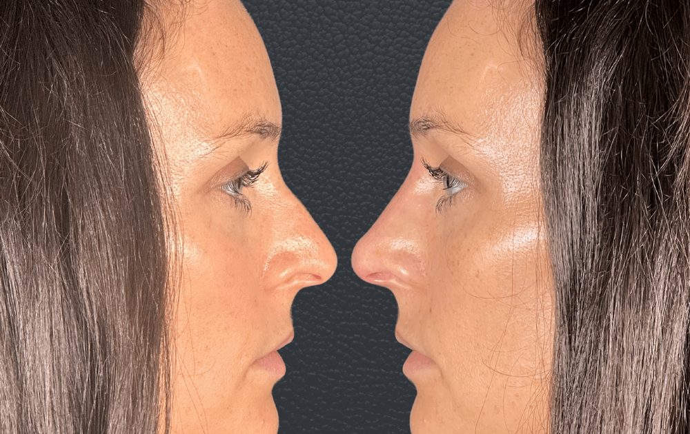 Before and after non-surgical nose job — bump on the bridge