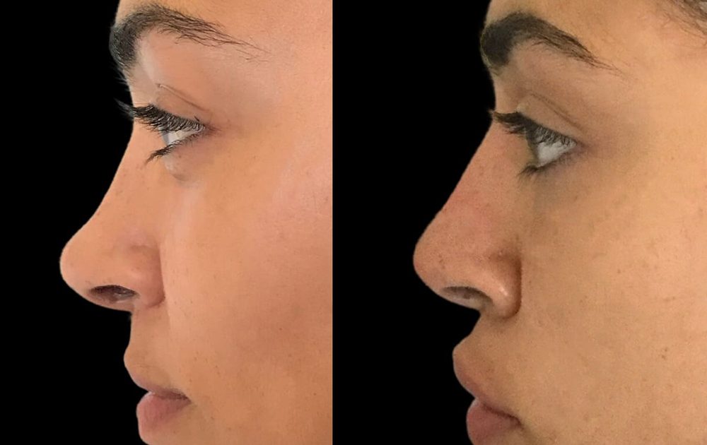 Before and after non-surgical nose job — bridge enhancement and tip lift